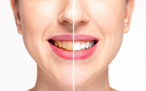 Teeth Whitening Milton Keynes St Neots