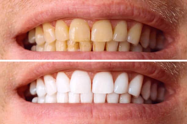 Laser White For Ever Bright – Get a Brighter, Whiter Smile with LA Teeth Whitening St Neots