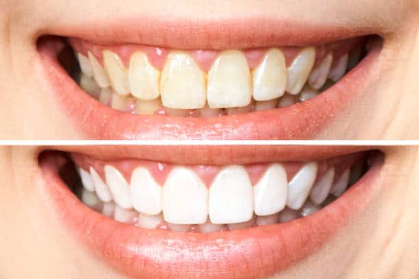 Achieve a Dazzling Smile for Your Special Day: A Guide to Wedding Teeth Whitening St Neots