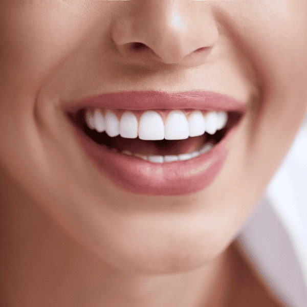 Get A whiter smile fast! Book with LA Teeth Whitening today! St Neots